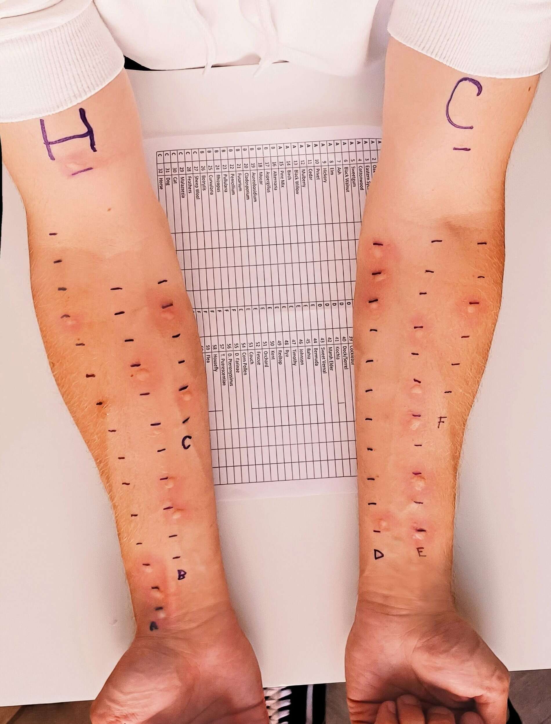 Allergy Testing